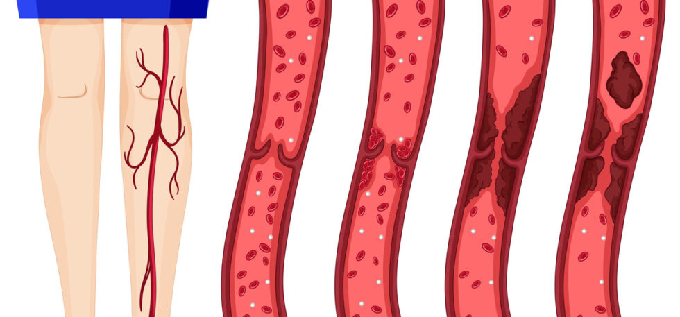 Arterie e Trombosi